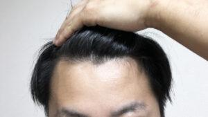 【薄毛の前兆】ハゲてきたら何をすればいい?進行を止めるには?